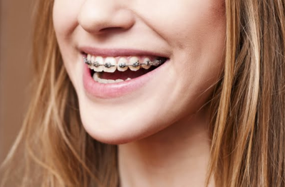 This is the image for the news article titled Playing Sports with Braces