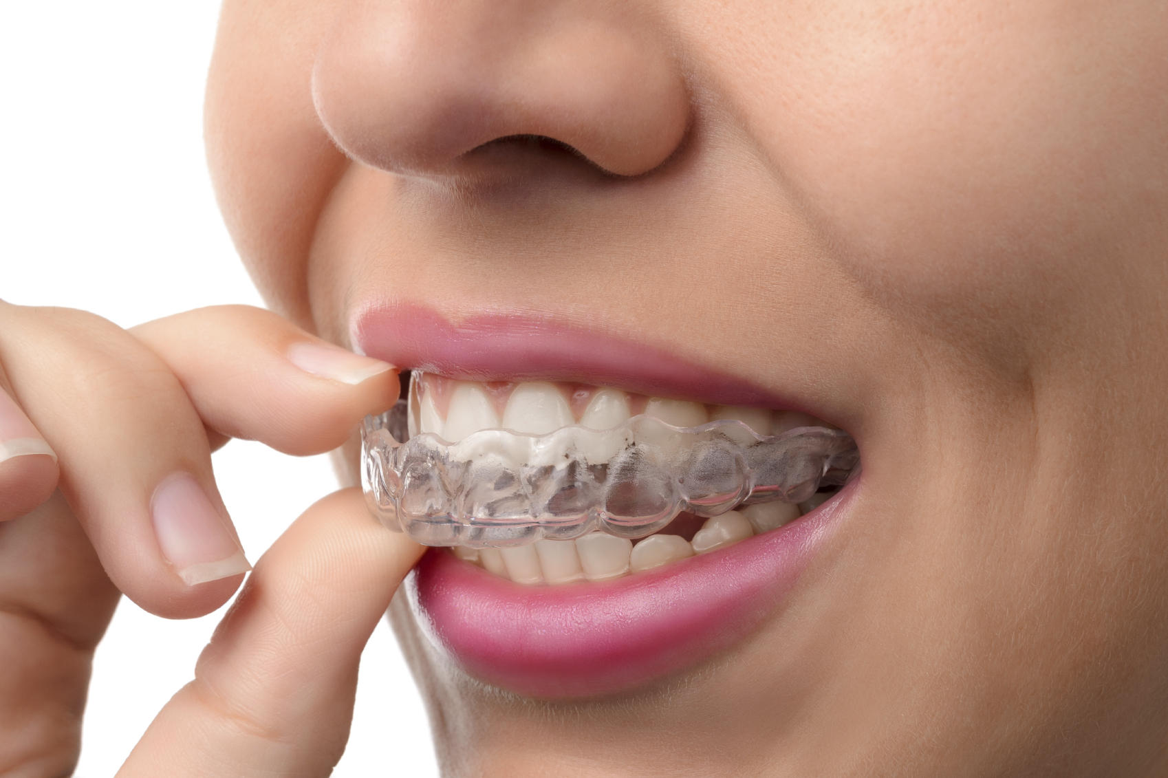 This is the image for the news article titled The Clear Pros of Invisalign Teen