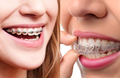 This is the image for the news article titled Braces vs. Invisalign